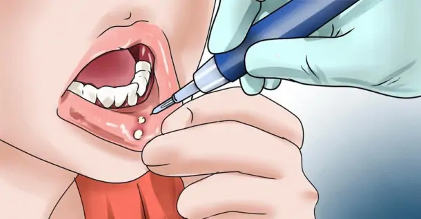 Cách chữa nhiệt miệng hiệu quả tại nhà hiệu quả