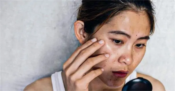 Cách làm mát da khi bị cháy nắng nhanh chóng tại nhà