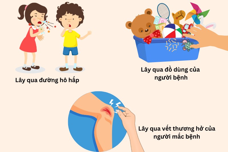 Bệnh bạch hầu lây qua đường hô hấp và tiếp xúc