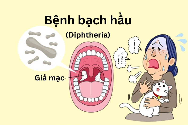 Bệnh bạch hầu xuất hiện giả mạc trong vòm họng