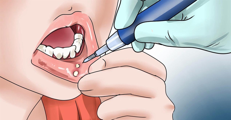 Cách chữa nhiệt miệng tại nhà mà bạn không nên bỏ qua
