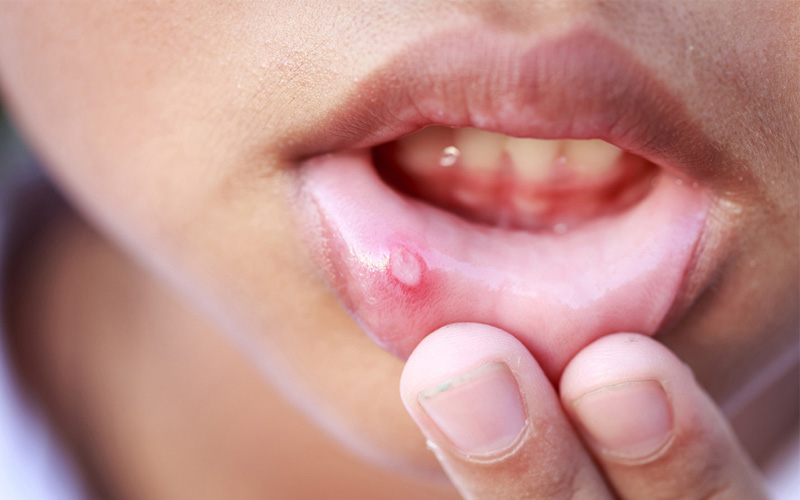 Nhiệt miệng có các triệu chứng dễ nhận biết