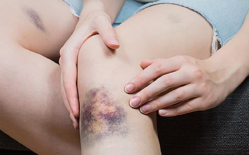 Máu bầm có thể xuất hiện do nhiều nguyên nhân khác nhau