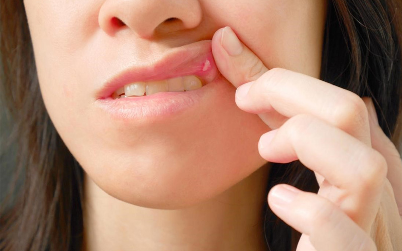Nhiệt miệng xuất phát từ nhiều nguyên nhân khác nhau