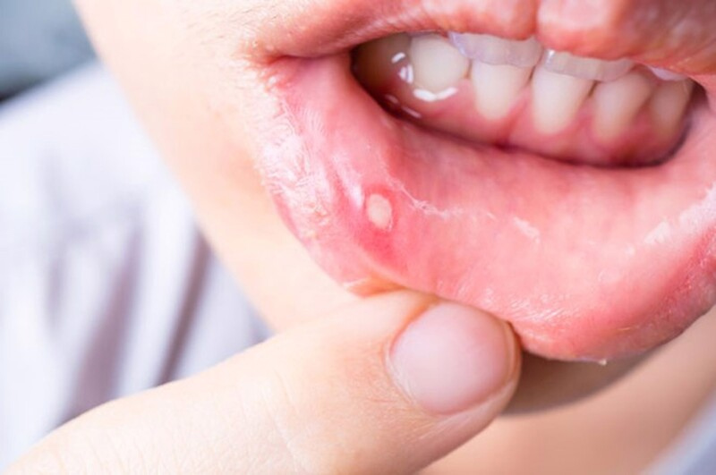 Nhiệt miệng là tình trạng xuất hiện các vết loét nhỏ ở niêm mạc miệng