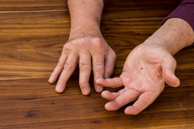Ý nghĩa nốt ruồi theo đường chỉ tay