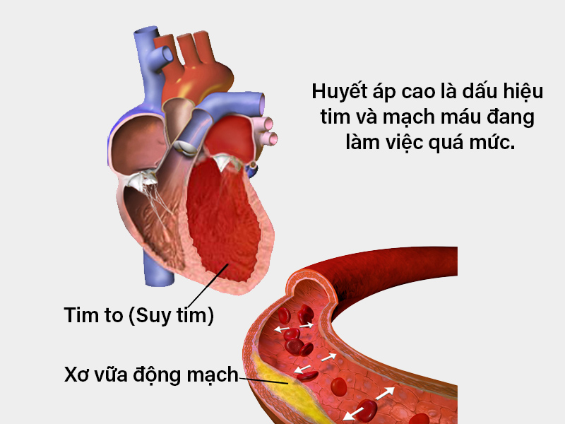 Cao huyết áp là bệnh lý phổ biến