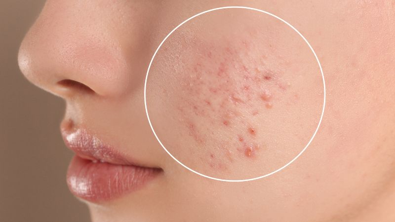 Da mặt bị nóng và nổi mụn