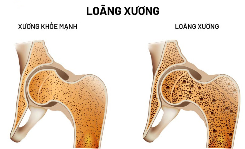 Loãng xương xảy ra khi giảm mật độ canxi trong xương 