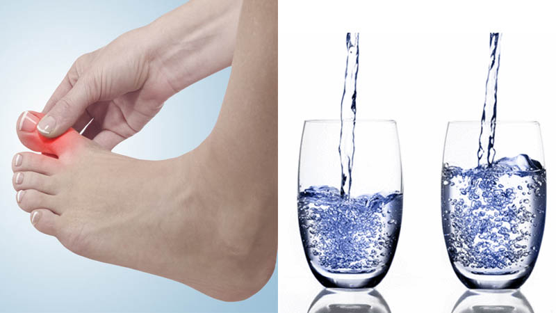 Nước ion kiềm hỗ trợ cải thiện bệnh gout